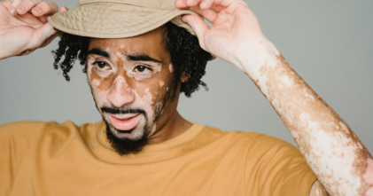 Casting homme avec vitiligo entre 25 et 35 ans pour publicité avec marque de prêt à porter