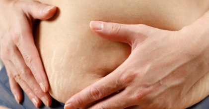 Casting femme avec cicatrice et vergetures sur le ventre pour tournage publicité