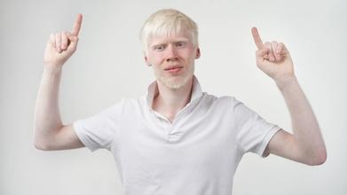 Casting modèle homme et femme albinos pour shooting photo