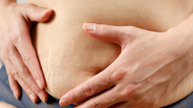 Casting femme avec cicatrice et vergetures sur le ventre pour tournage publicité